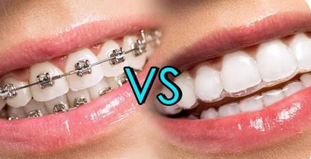 ClearvsBraces